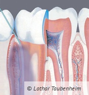 Diffusion der ILA – auch in den Knochen.