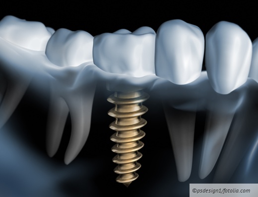 Prothetische Indikationen für Implantate