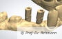 Intraoraler Scan der Präparation und der Implantatposition.