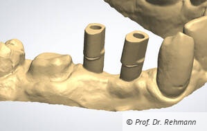 Intraoraler Scan der Präparation und der Implantatposition.