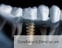 Abrechnung einer Implantatversorgung mit Wurzelstiftkappen auf Implantaten und Stege mit individuellen Steggeschieben Abrechnung einer Implantatversorgung mit Wurzelstiftkappen auf Implantaten und Stege mit individuellen Steggeschieben