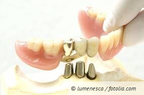 UK-Stegkonstruktion: Änderung in Locator und Erneuerung der Prothese