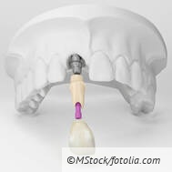 So wenden Sie die beb-97-Nr. 6471 richtig an