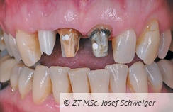Abb. 3 und 4: Der Einstieg in die virtuelle dentale Welt erfolgt mit dem Intraoralen 3D-Scanner. Neben den Oberflächendaten sind moderne IO-Scanner in der Lage, beispielsweise die geometriebezogene Farbe der Mundsituation aufzunehmen.