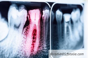 Abrechenbarkeit BEMA-Nr. 32 (WK)