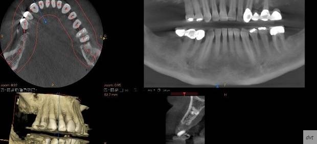dvt 620x282.jpg 505cb18384028f72d0dc6d6277a67c52