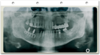 Röntgensichthülle Orthopantomograph mit Abheftrand 1007024209